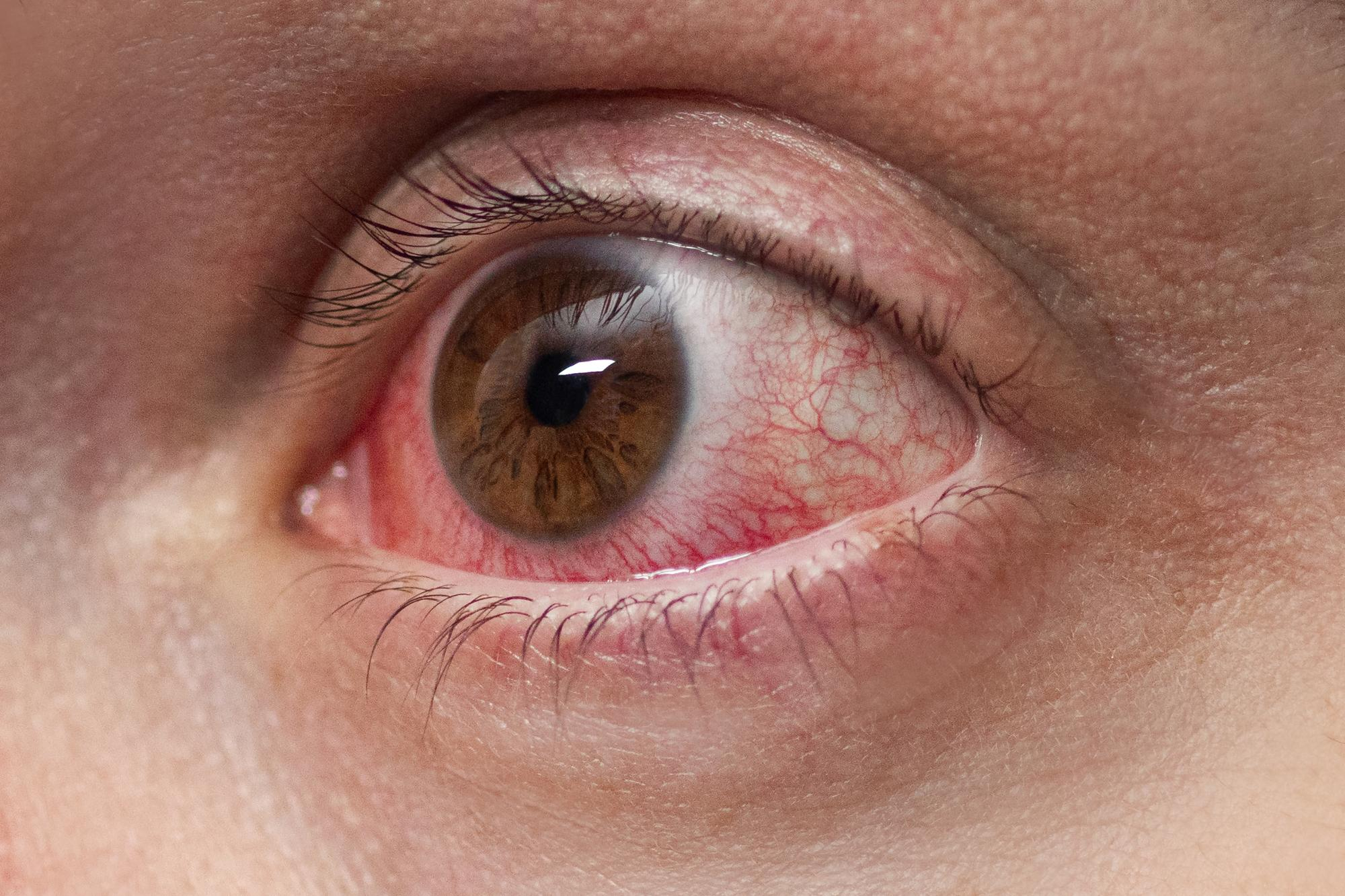 Tratamiento Rosacea Ocular en Fuengirola