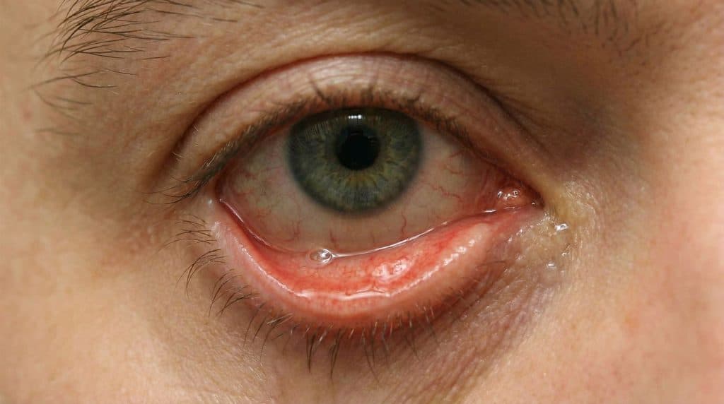 árpado inferior descolgado por ectropión en paciente adulto