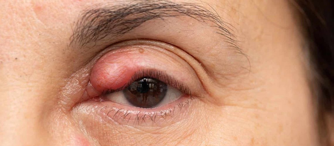 Chalazion tratamiento en fuengirola