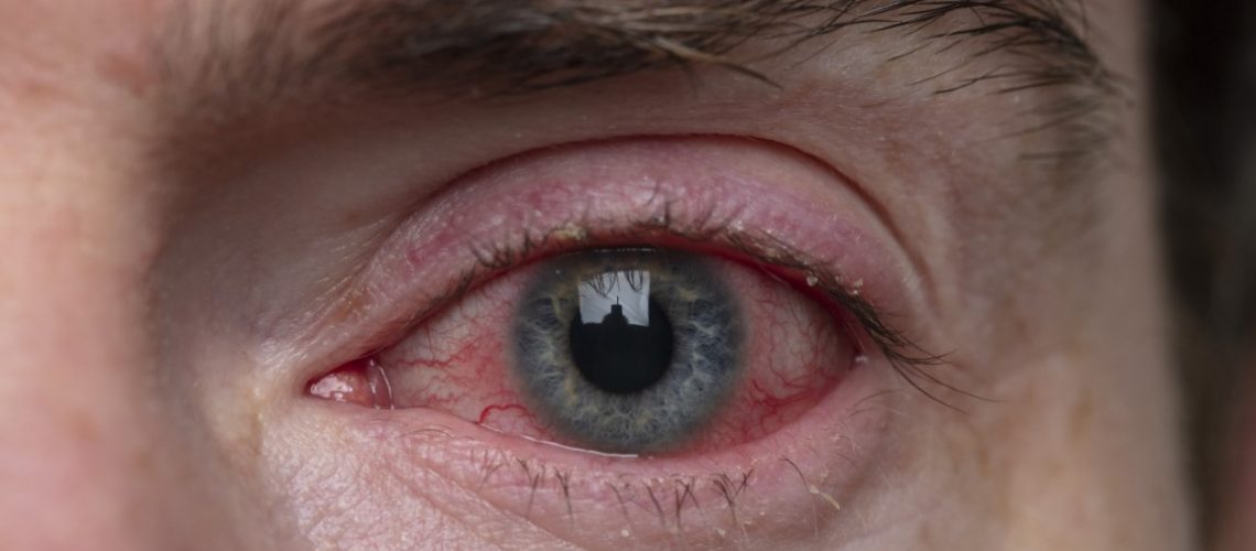 Derrame ocular tratamiento en fuengirola-mijas
