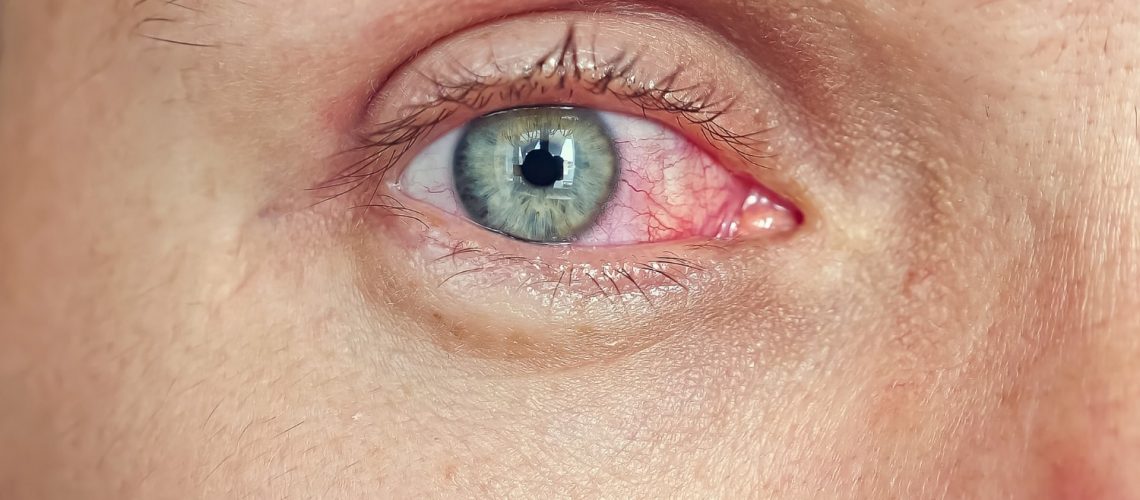Hiperemia Conjuntival Fuengirola