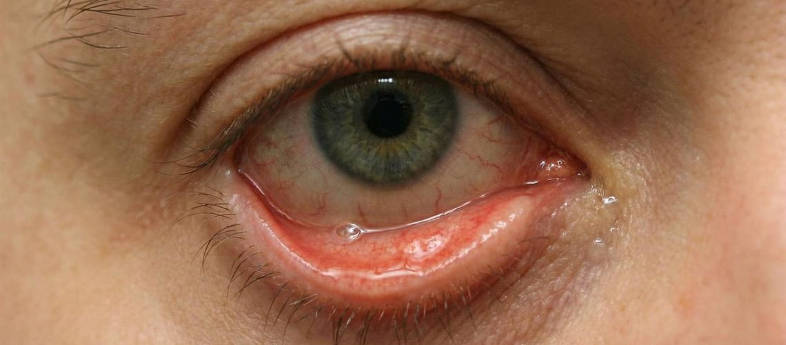 árpado inferior descolgado por ectropión en paciente adulto