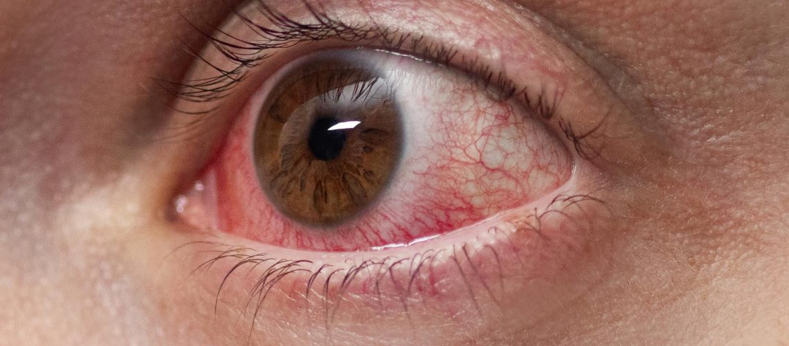 Tratamiento Rosacea Ocular en Fuengirola