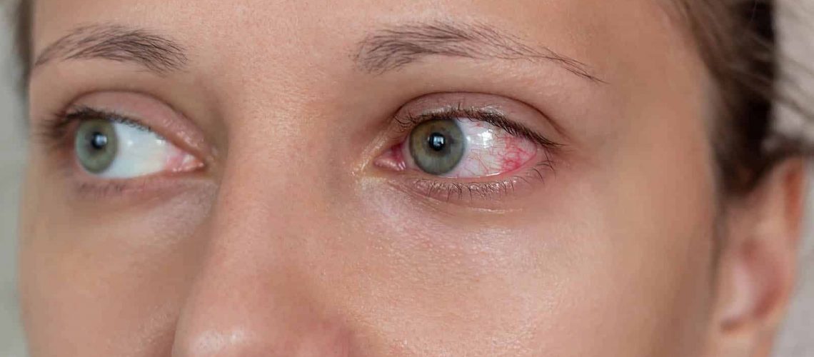 Tratamiento Queratitis en Fuengirola
